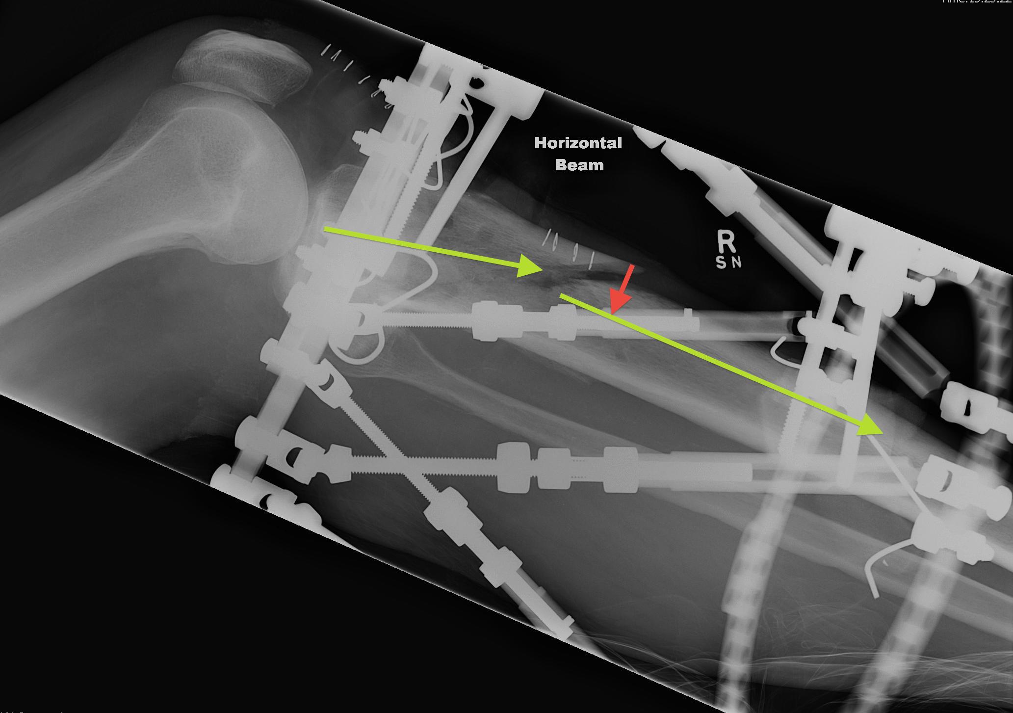 TSF Lateral View Angulation and Translation